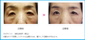 眉下切開ビフォーアフター