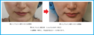 唇のヒアルロン酸注入前後
