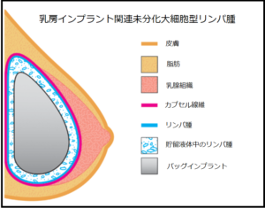 乳房インプラント関連未分化大細胞型リンパ腫