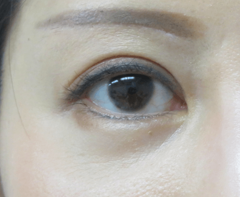 【若い人に人気!眉下切開が自然に二重幅を広げる】専門医による解説