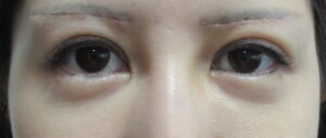 眉下切開術後1か月目