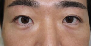 眉下切開男術後6か月