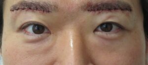 眉下切開男術直後