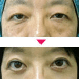 【まぶたのたるみ除去に眉下切開が良い理由】眉下切開の詳細解説