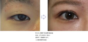 切らない眼瞼下垂治療ビフォーアフター