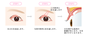 切らない眼瞼下垂治療イラスト3
