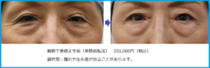 眼瞼下垂挙筋前転術