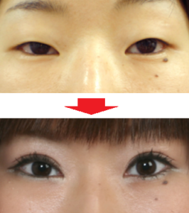 眼瞼下垂挙筋前転術とは
