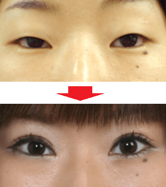 【挙筋前転術の全容】切開による眼瞼下垂治療について