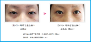 切らない眼瞼下垂治療ビフォーアフター2