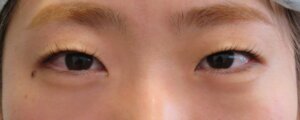 切らない眼瞼下垂治療の治療前