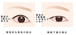 切らない眼瞼下垂治療イラスト