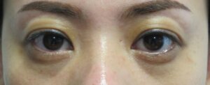切らない眼瞼下垂治療手術後