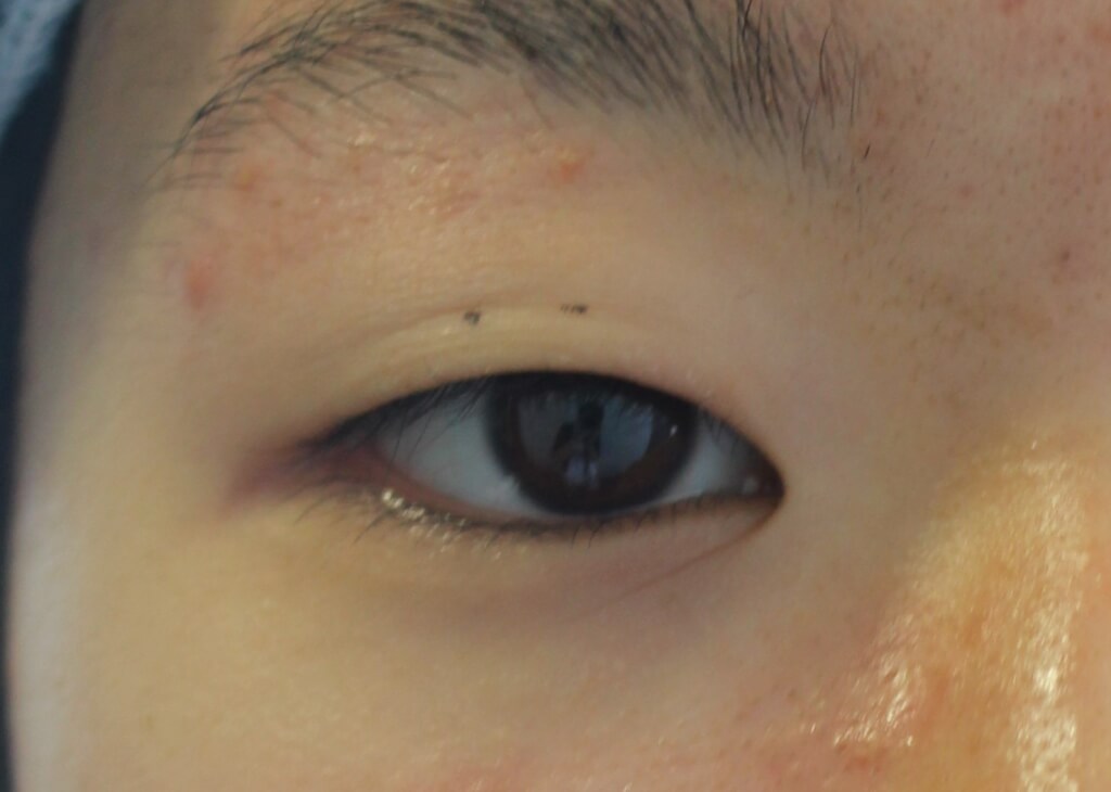 40638切らない眼瞼下垂の治療法まとめ:保険適用は? 埋没法との違い