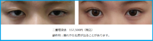 二重埋没法ビフォーアフター