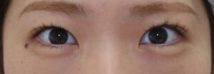切らない眼瞼下垂治療の治療後