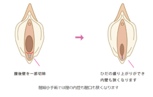 膣縮小の手順