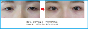 切らない眼瞼下垂のビフォーアフター