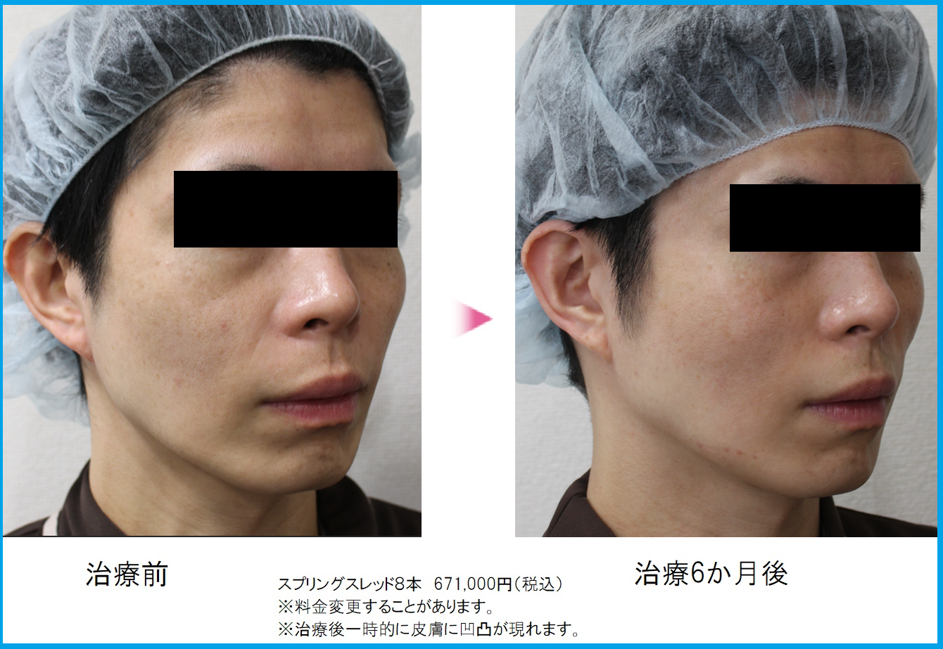 スプリングスレッド男性ビフォーアフター写真2