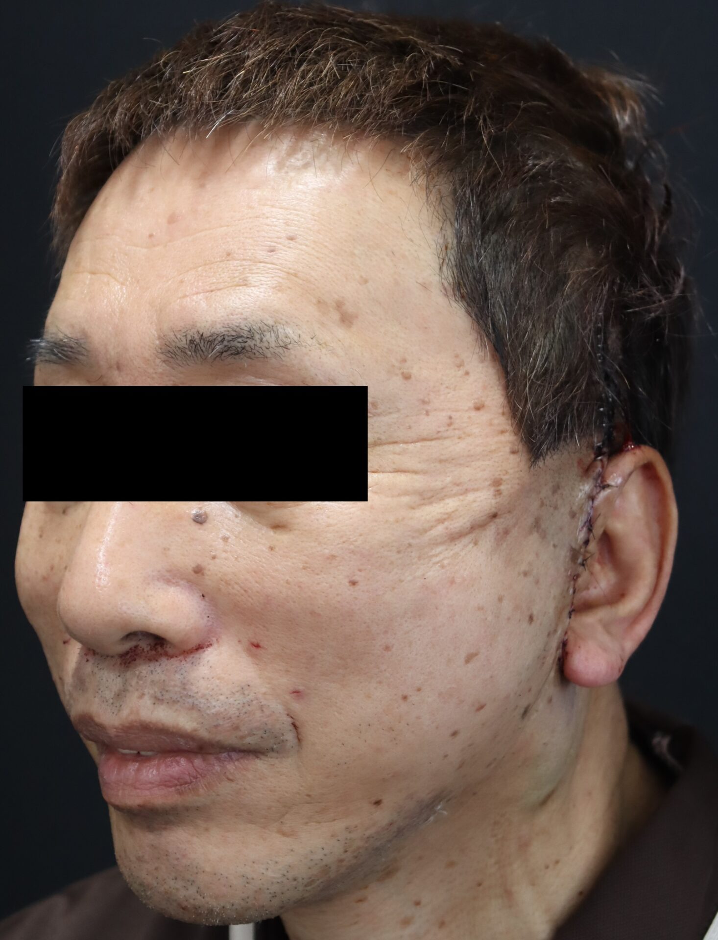 男性のフェイスリフト手術・メンズアンチエイジング治療の特徴