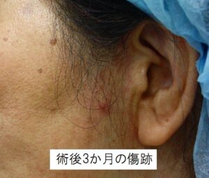 切開フェイスリフト手術の傷跡
