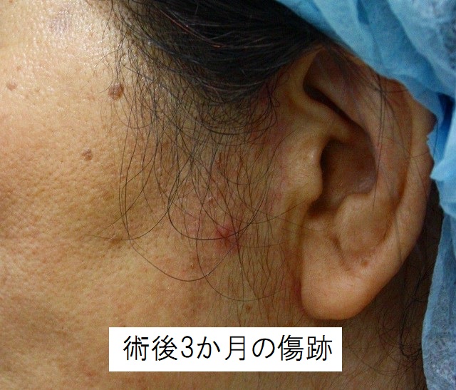 切開フェイスリフト手術の傷跡:傷跡が目立つ要因とは