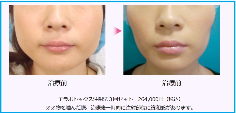エラボトックス前後