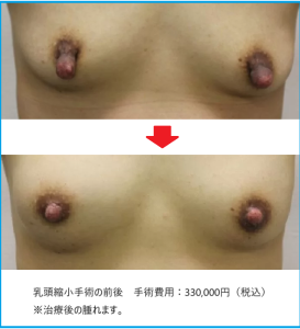 乳頭縮小手術前後
