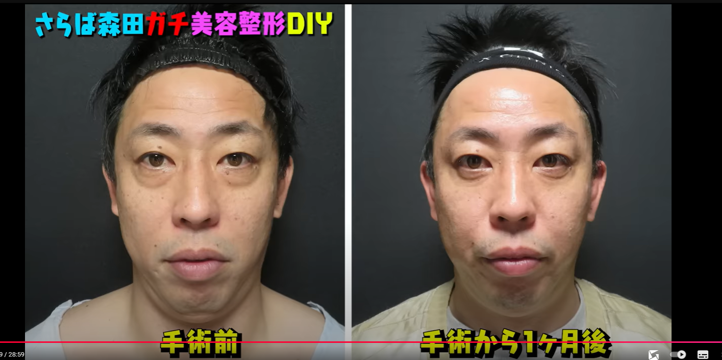 「さらば青春の光」森田哲矢さんのクマ取リ整形解説