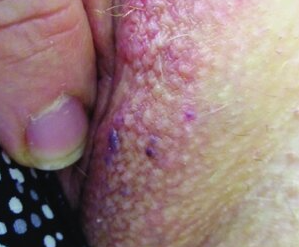 女性の外陰部被角血管腫