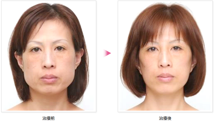 【エラボトックスで小顔に】半永久効果が持続する独自アプローチとは?