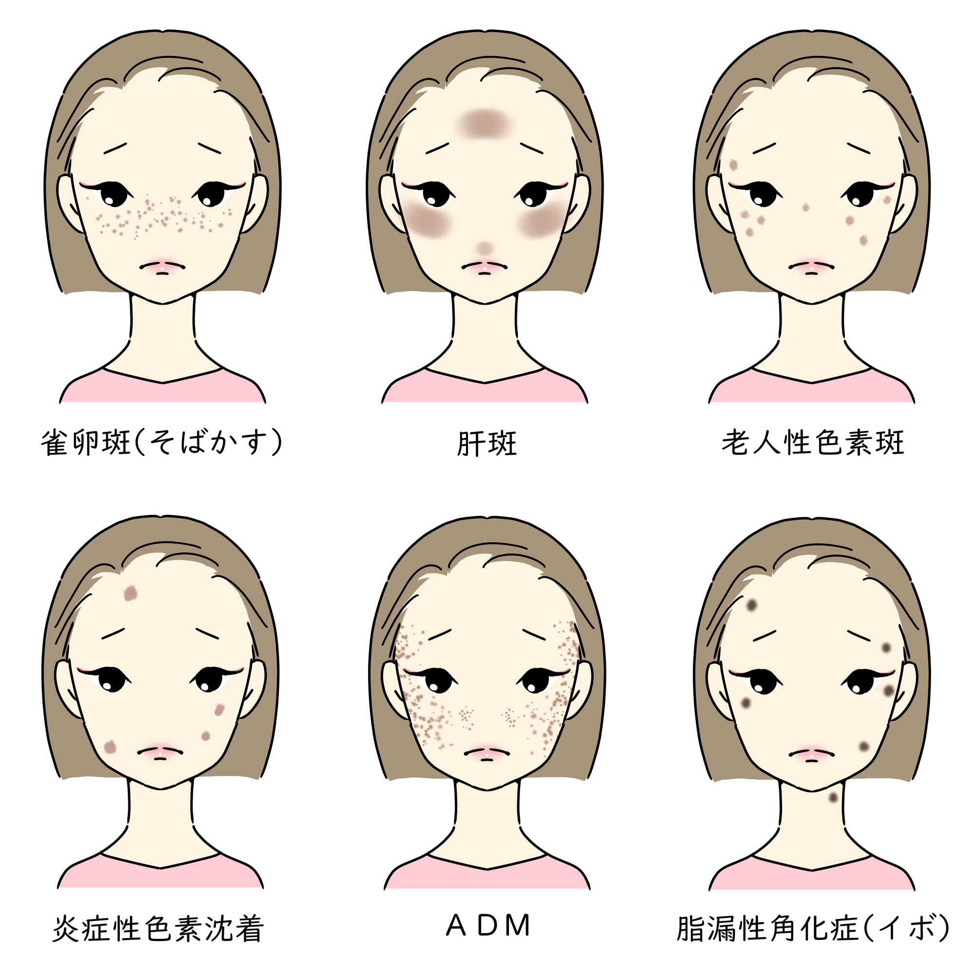 シミの種類の見分け方と対策