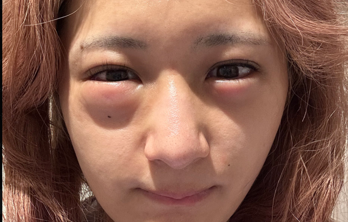 しなこも体験!顔がパンパンに腫れる『クインケ浮腫』って何?!