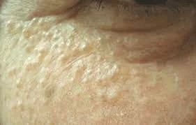 エクリン汗嚢腫は皮膚科で保険適用で治せる?徹底解説