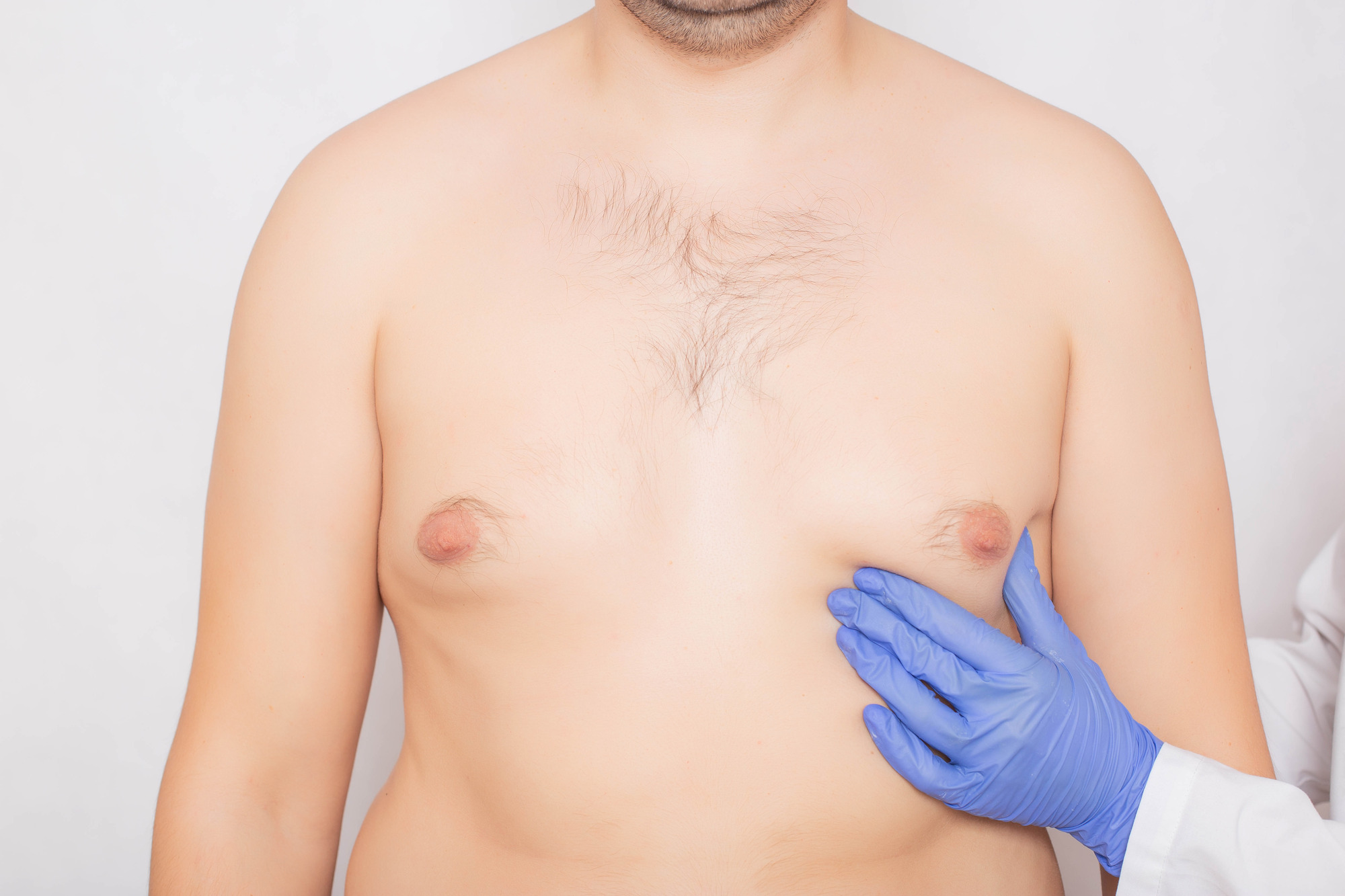 偽性女性化乳房の原因とは？肥満のせい？