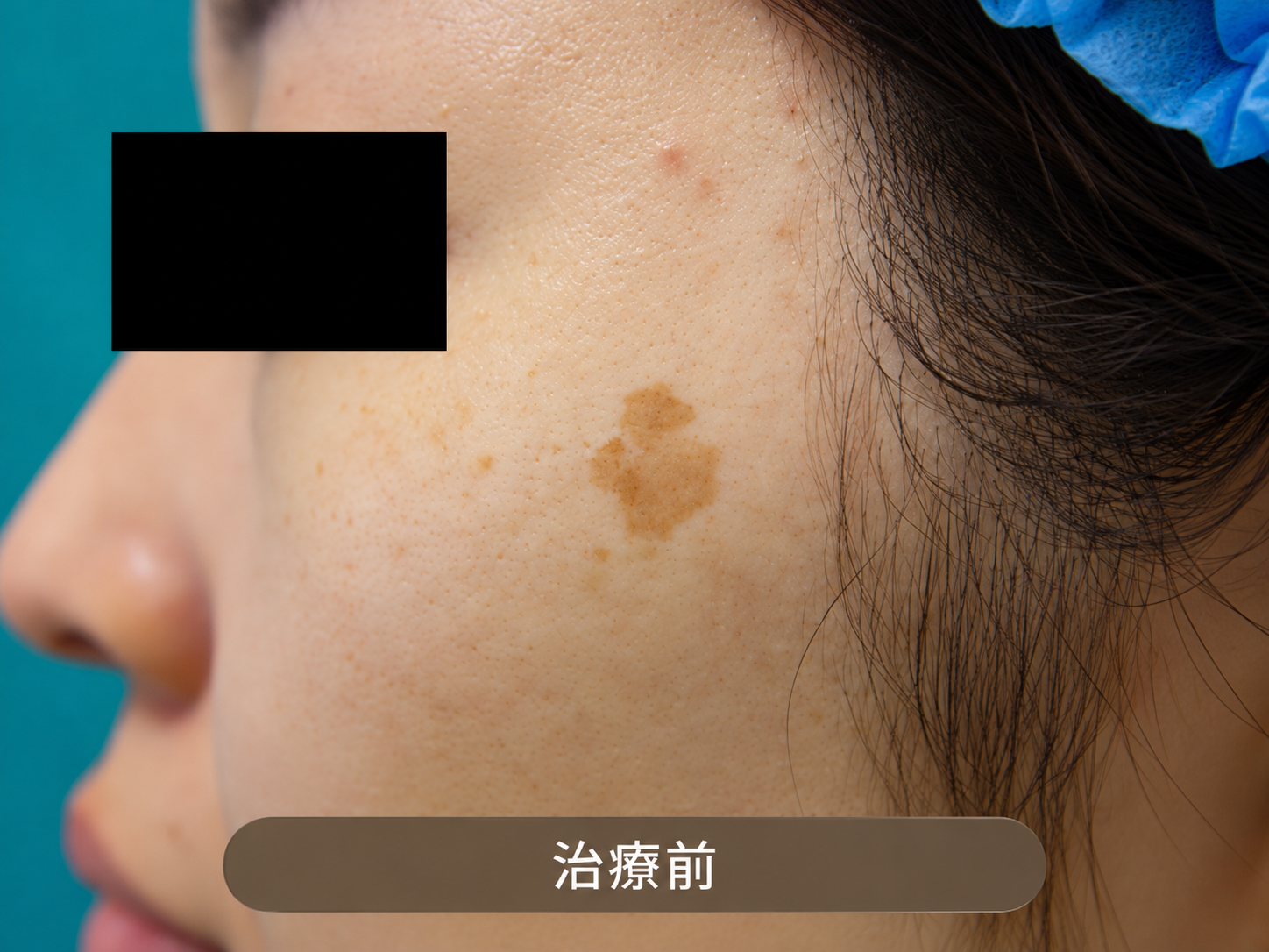治療前の肌状態（老人性色素斑）