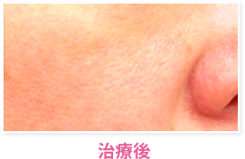 治療後