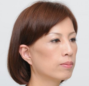 フェイスリフト手術（モニター解説No.4最終回）