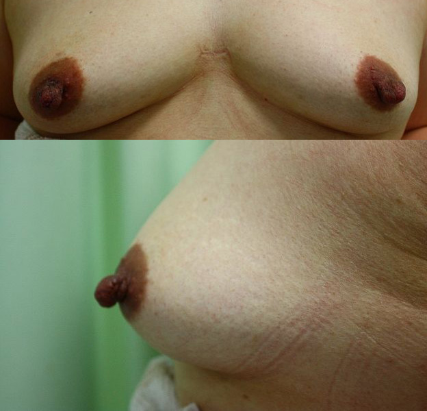 乳頭縮小手術 （患者様のご希望に添えず、再手術をした症例）