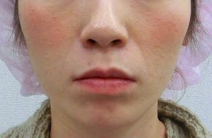 エラボトックス注射による小顔治療