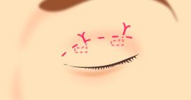 The most popular operation for creating  “double eyelid”