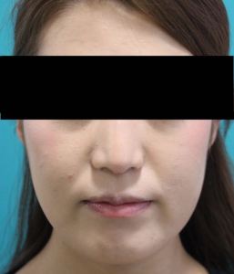 20代でもウルセラ②