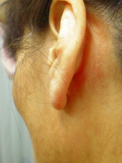 フェイスリフト左2