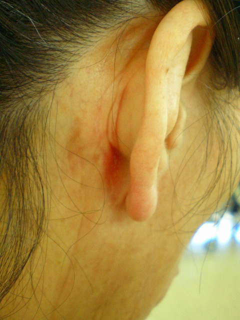 フェイスリフト右2