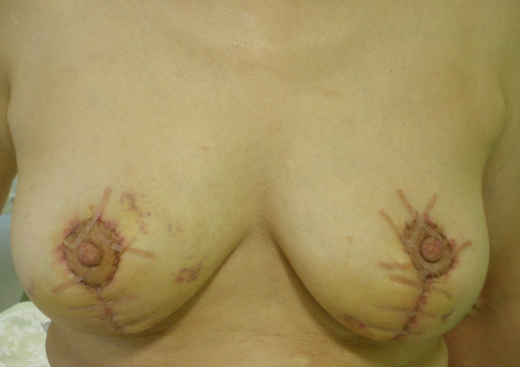 乳房挙上手術後