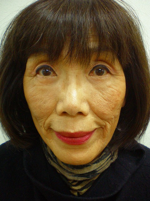 アンチエイジング後