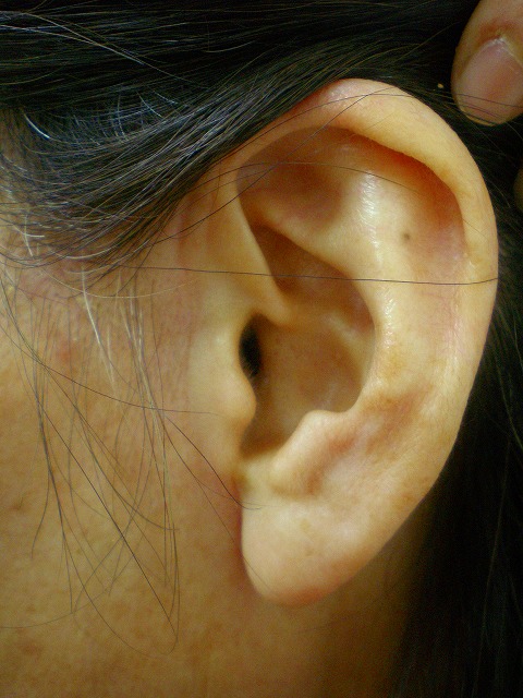 フェイスリフト左1