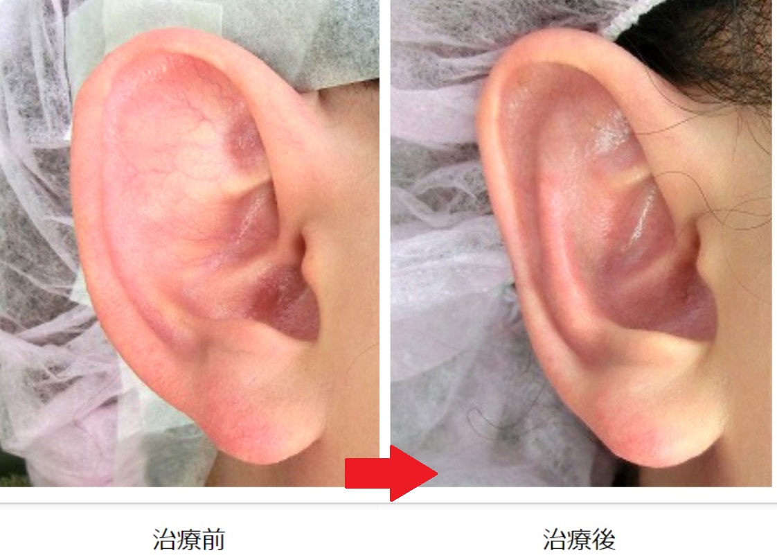 【耳朵缺损案例】打架被人咬掉一块耳朵，手术后恢复得不错_耳部整形_耳部整形治疗介绍 - 好大夫在线