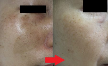 扁平母斑と日光性色素斑のレーザー治療