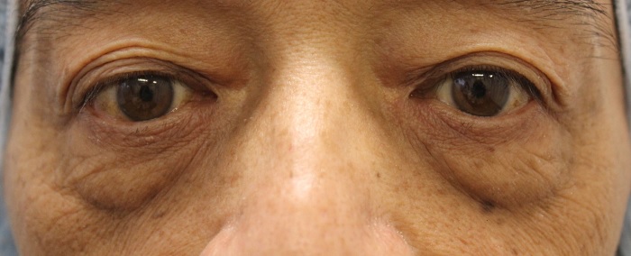 下眼瞼手術 術後のアッカンベーについて 美容整形 美容外科 船橋中央 青山セレスクリニック